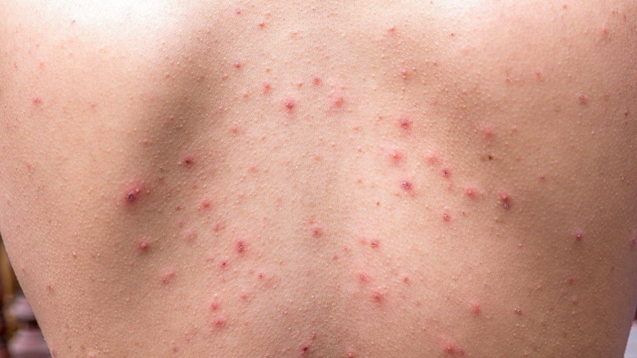 How to Prevent and Treat  Common Skin Conditions