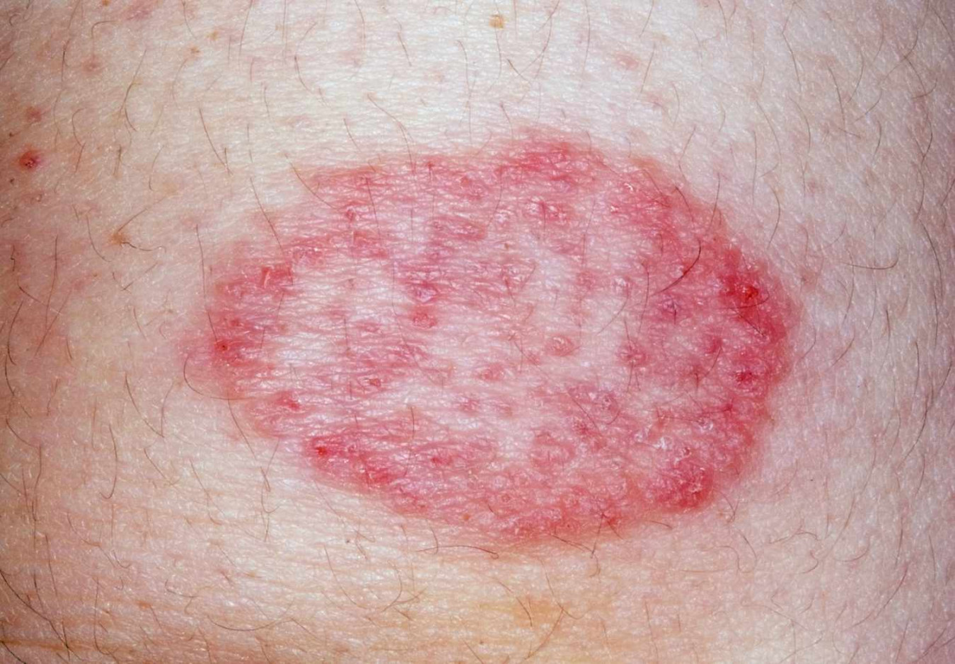 Skin Conditions: Pictures, Symptoms, Treatment